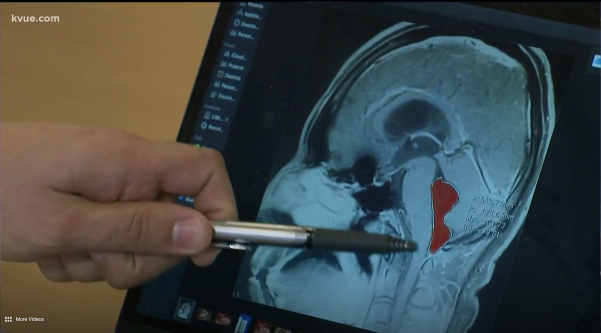 Doctors in Texas surgically removed a tape worm from a man’s brain, they say.