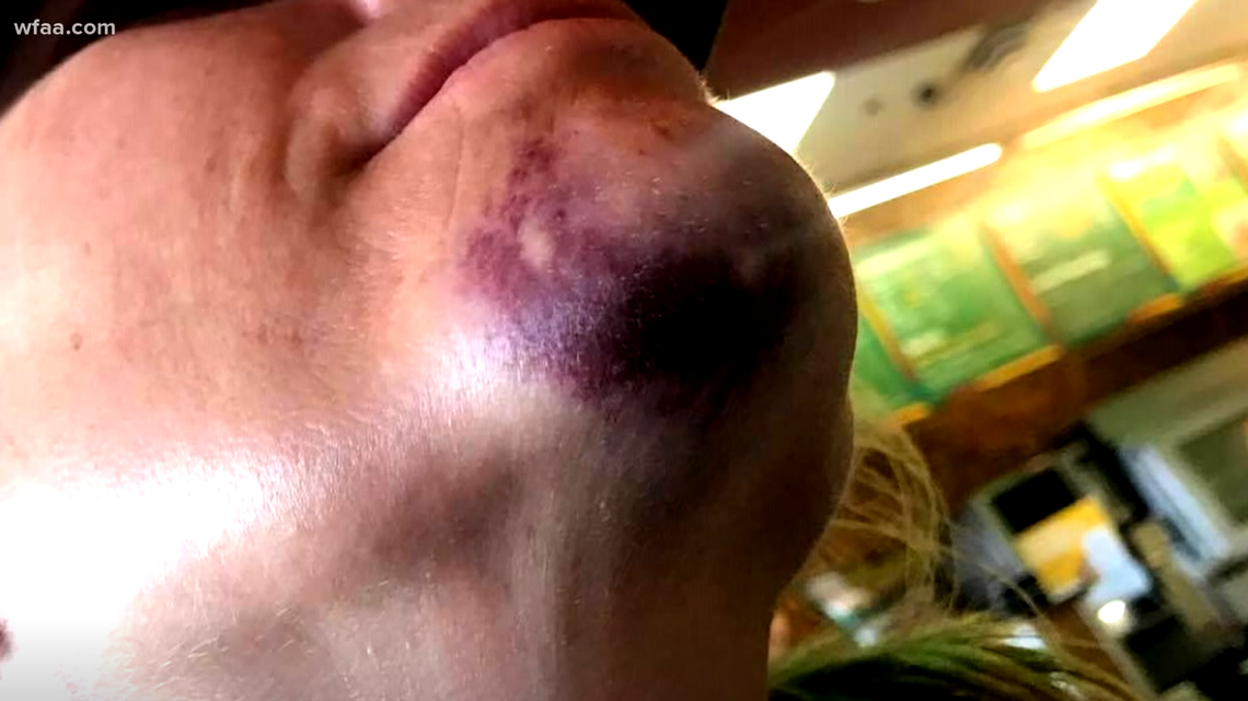 This photo from a parent shows a bruise on the parent's chin she says was sustained by getting hit with a foul ball at Zinger Bat Ballpark in McKinney.
