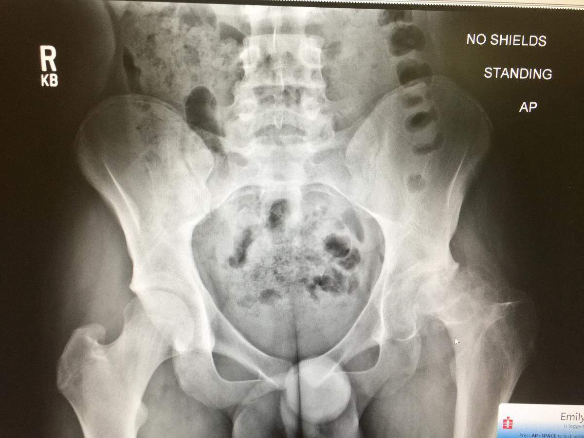 Arlington Heights senior Brennan Best had a hip replacement two years ago.