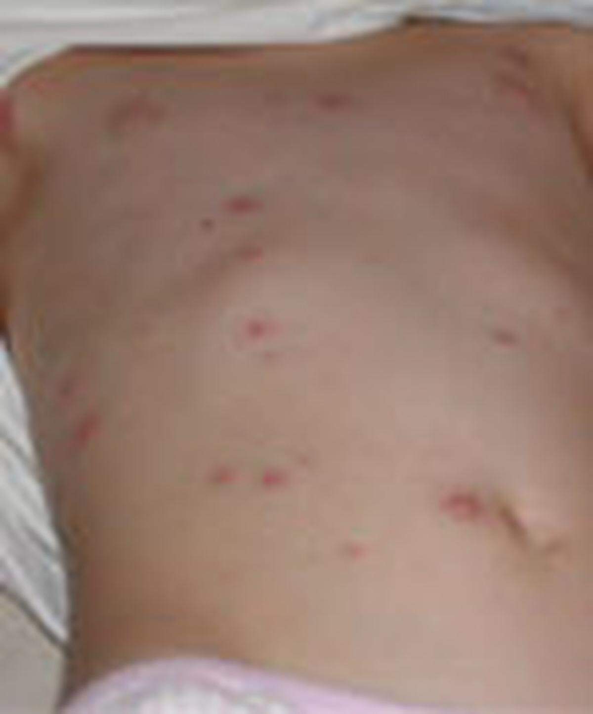 A vaccinated case of chickenpox that appears milder with less rash.