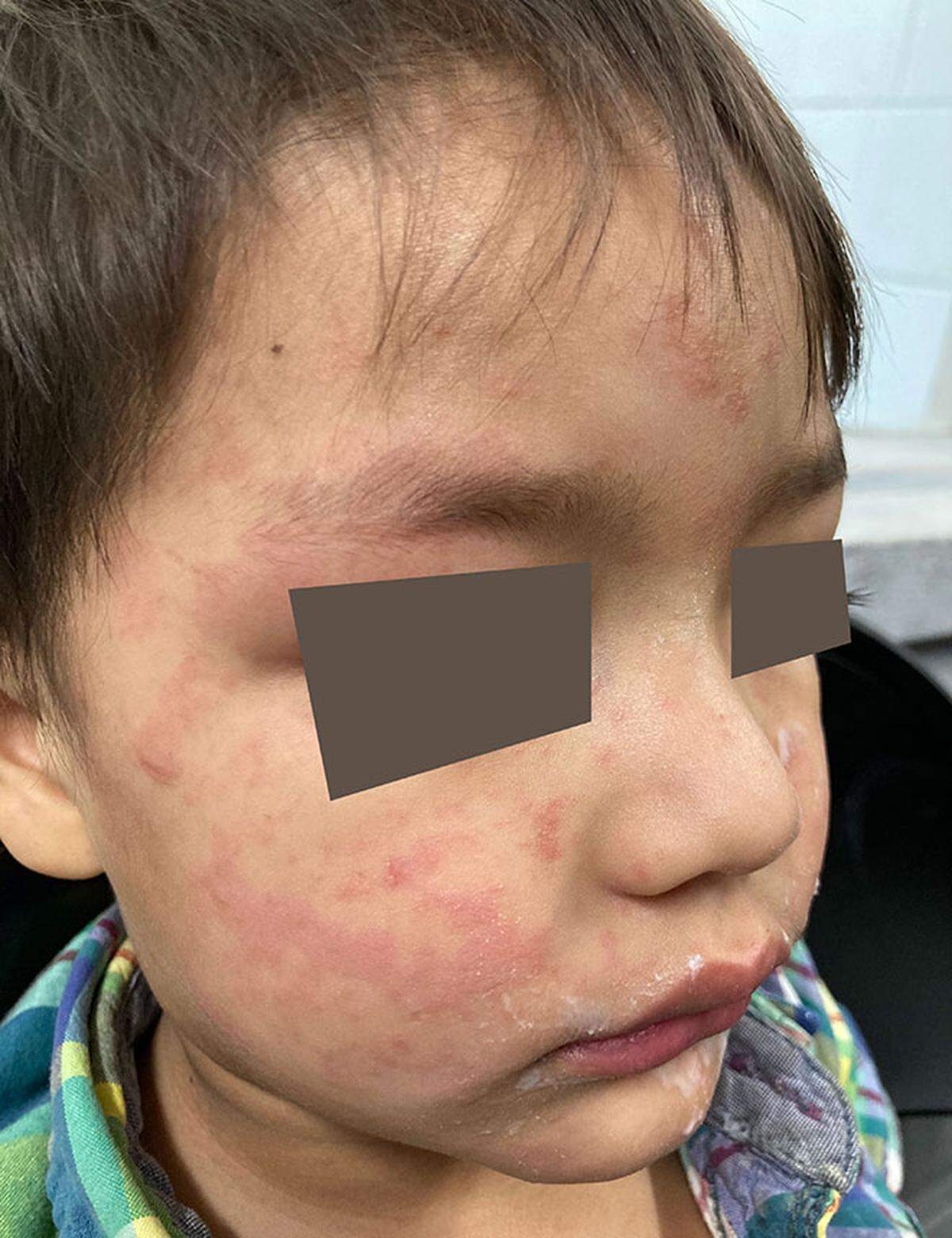 A child’s face and forehead show the maculopapular rash from measles,