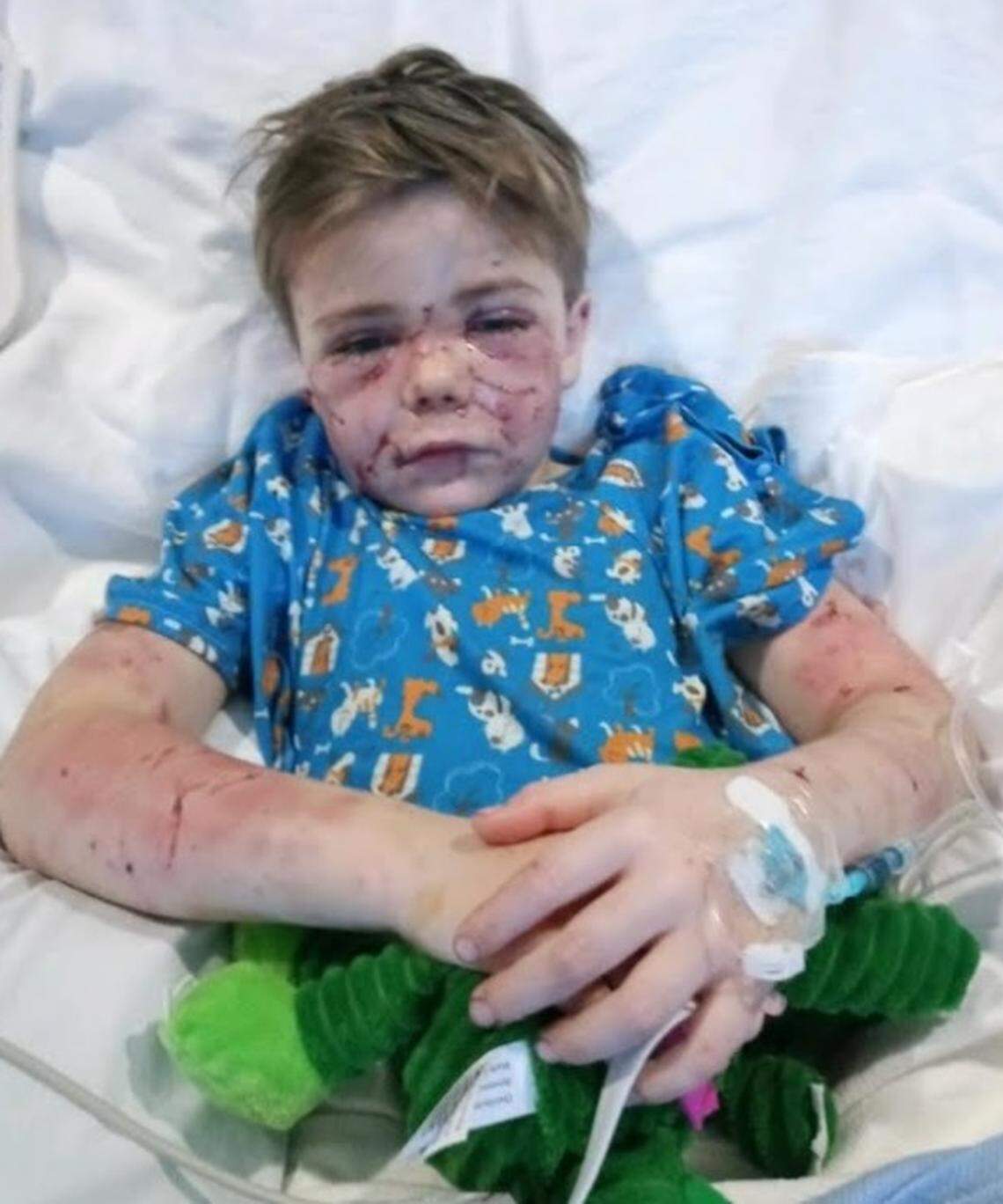 7-year-old Conner Landers of Parker County suffered lacerations and puncture wounds all over his body during a dog attack in late January.