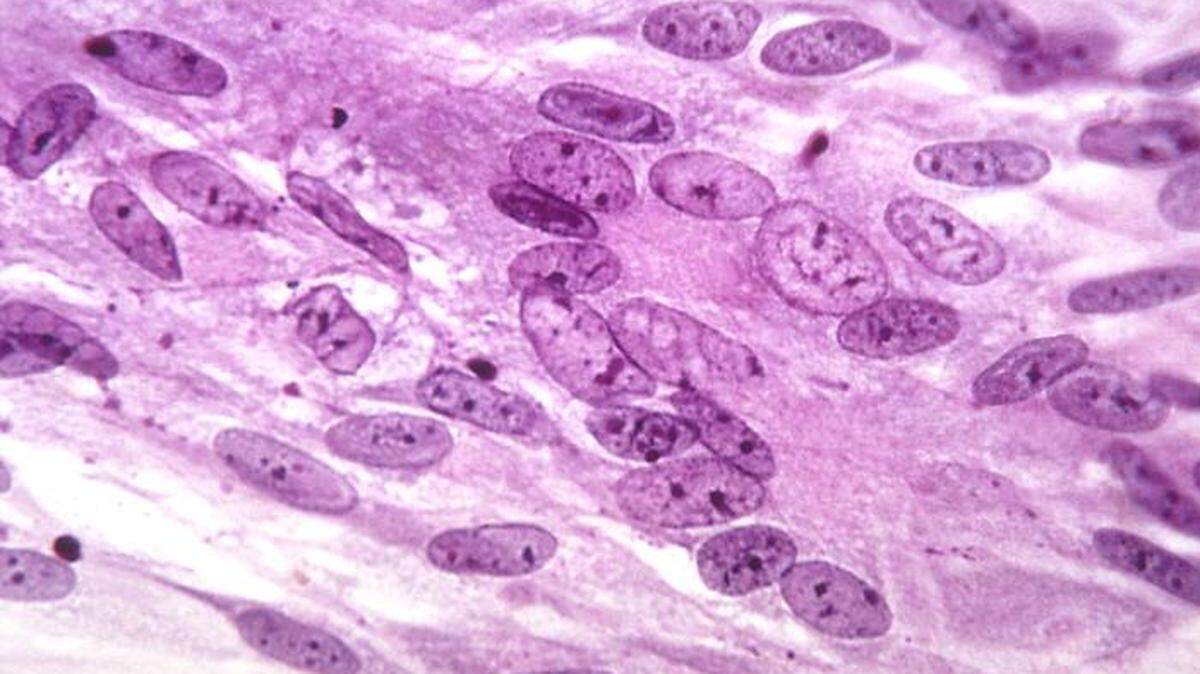 The varicella-zoster virus, also known as chickenpox.