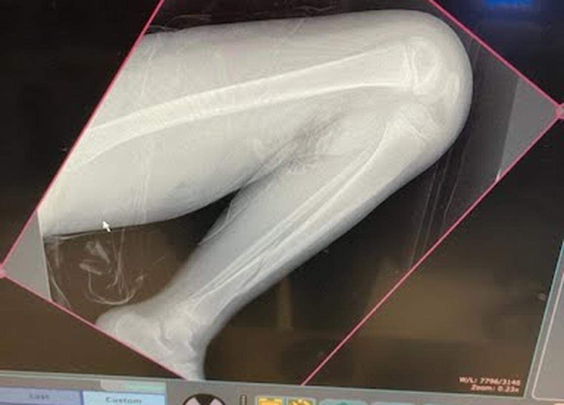 Micah Reed, 8, broke his leg (seen near his ankle) at a North Texas trampoline park.