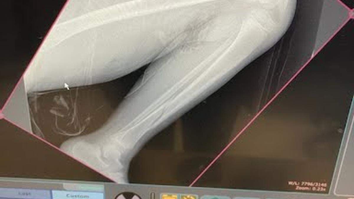 Micah Reed, 8, broke his leg (seen near his ankle) at a North Texas trampoline park. He’s now in a full leg cast and is temporarily confined to a wheelchair.