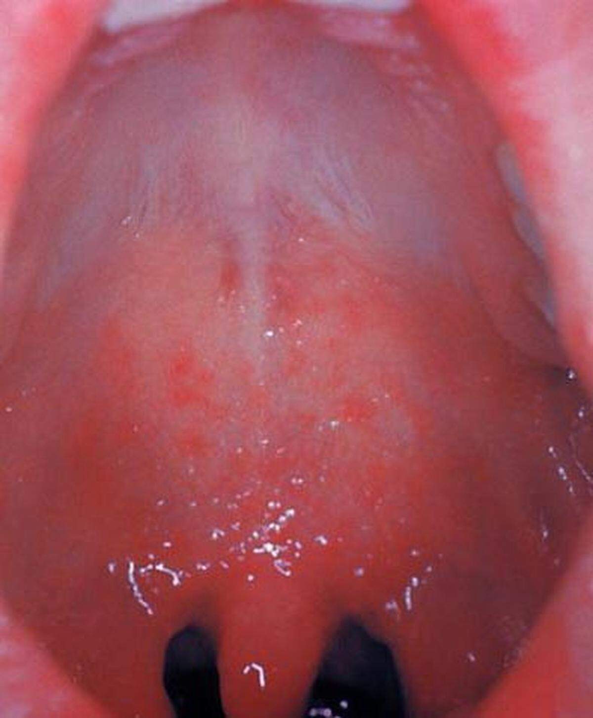 This was a patient who presented with Koplik’s spots on palate due to pre-eruptive measles on day three of the illness.
