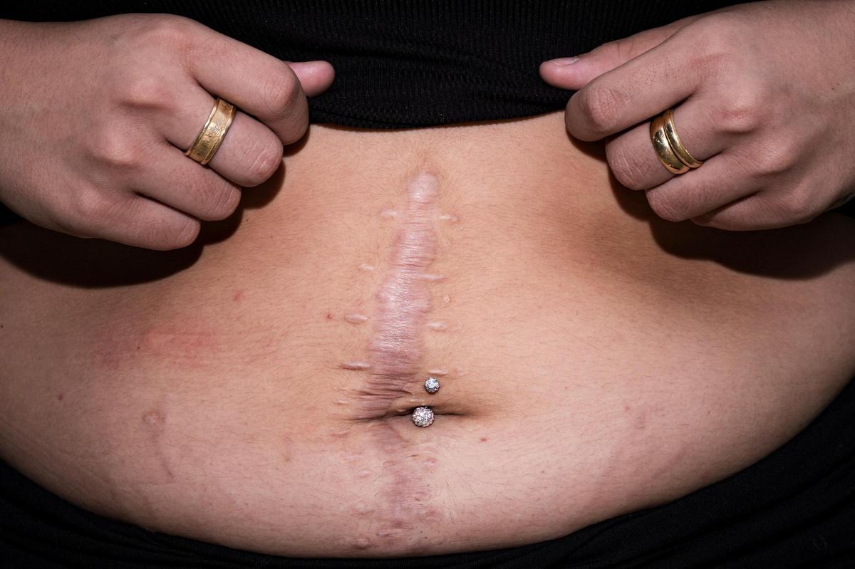 Mia Dominguez shows the surgery scar as a result of a bullet wound she suffered in the abdomen.