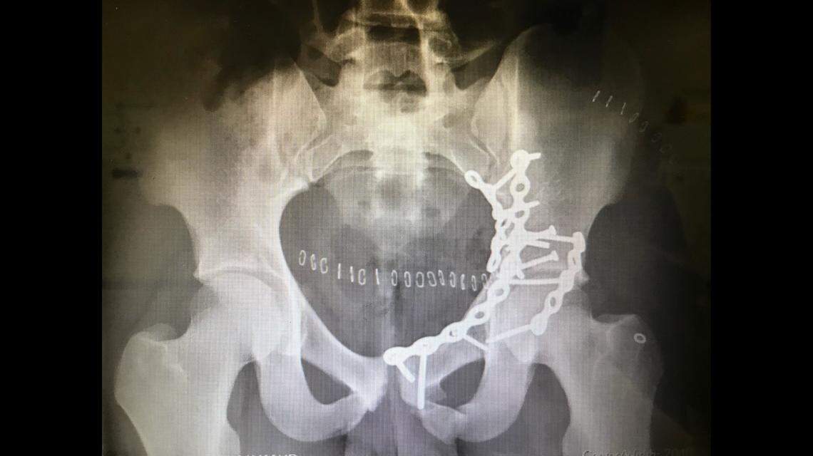 North Crowley senior Michael Hall broke his pelvis during a car accident in May 2020.