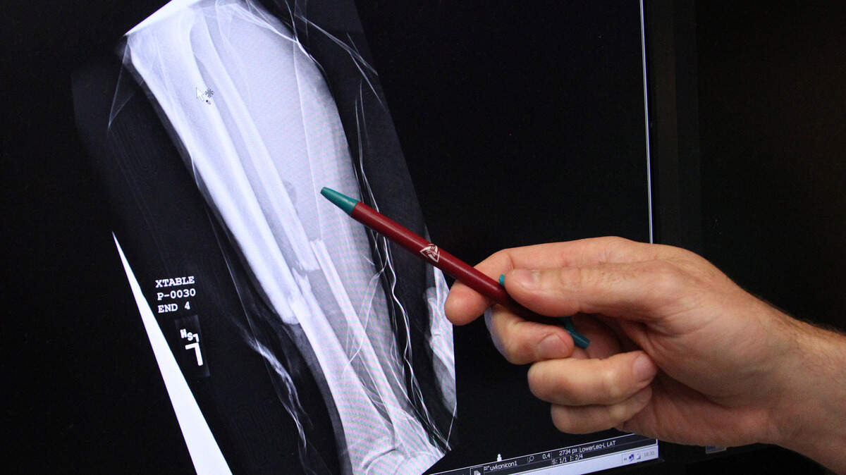 A trauma director at Utah Valley Regional Medical Center in Provo shows an X-ray of a fracture that happened in a jump gym in 2013. Utah enacted regulations to requires the operator of a trampoline park to obtain a business license. A local regulating authority can suspend or revoke a trampoline park’s business license for noncompliance.