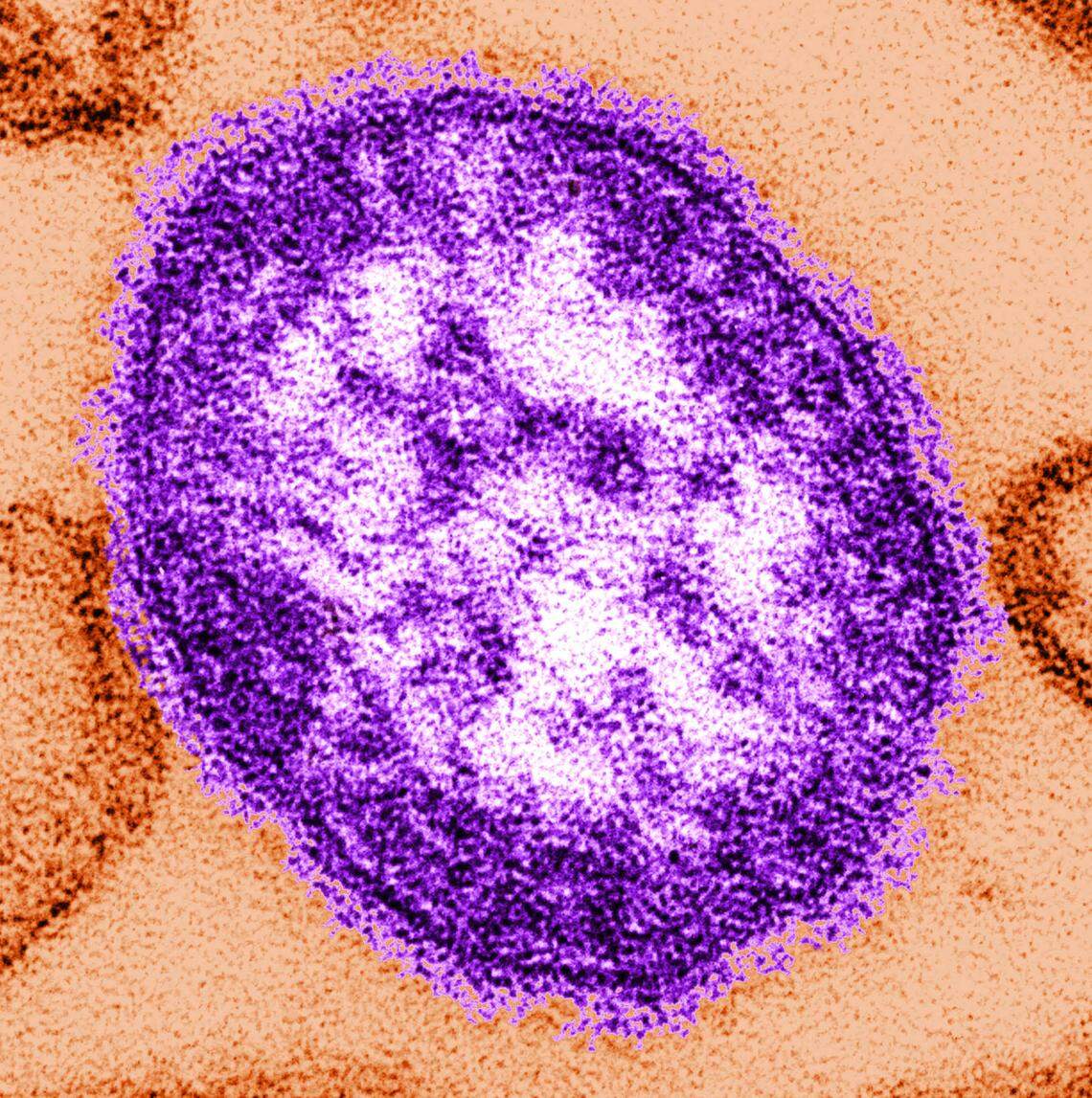 This undated image made available by the Centers for Disease Control and Prevention on Feb. 4, 2015 shows an electron microscope image of a measles virus particle, center. Measles is considered one of the most infectious diseases known. The virus is spread through the air when someone infected coughs or sneezes.