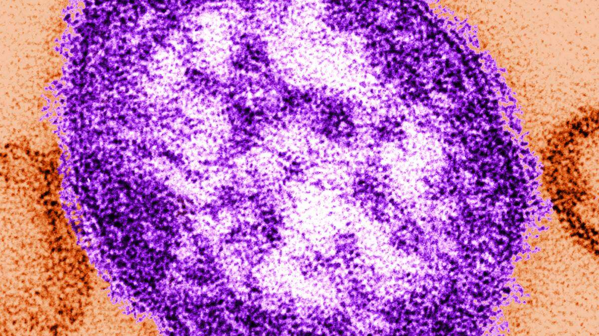 Tarrant County ‘getting ready for measles’ as West Texas outbreak grows