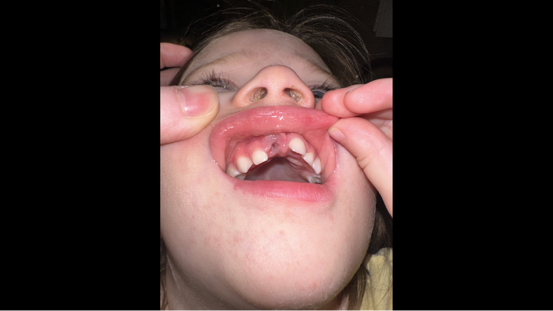 A toddler who tripped on a slippery floor face-first at a child care center in Lewisville, Texas, is shown with a missing tooth. Her parents are suing The Learning Experience — Castle Hills over allegations that staff neglected their daughter.