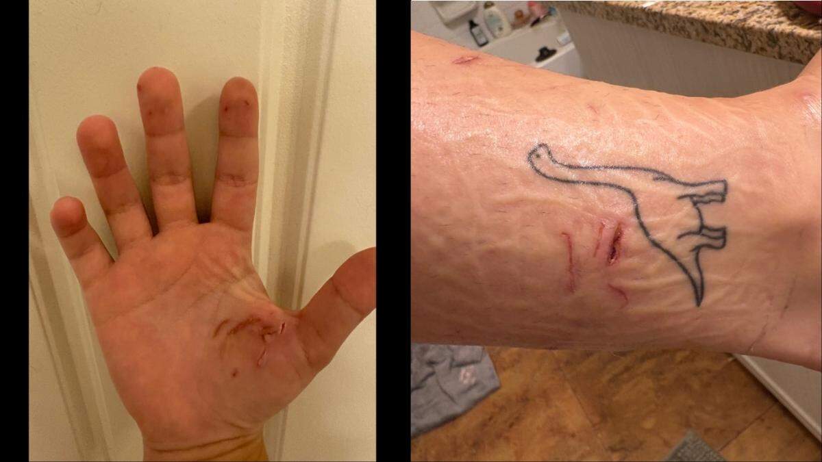 Michelle Danos was bitten many times during the attack, and these are just a few of the wounds.