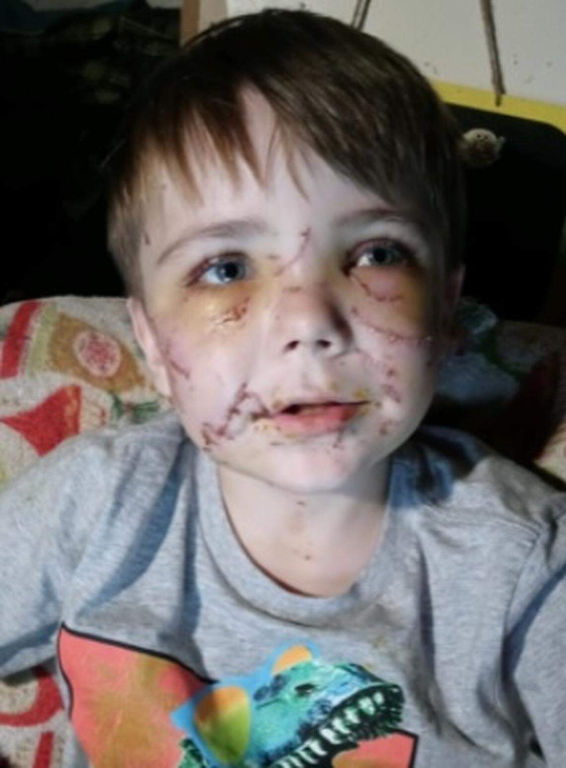 Conner Landers of Parker County was mauled by a dog as he walked home in late January.