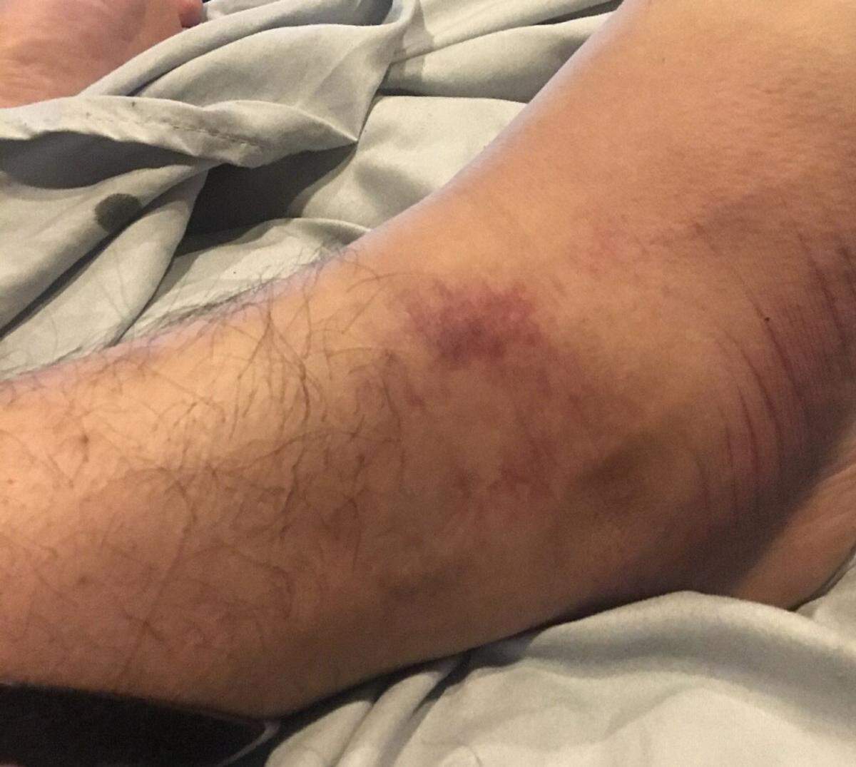 Jonathan Serna, 25, says he received a bruise on his elbow and several other superficial injuries when he was arrested after a protest in Fort Worth on May 31.
