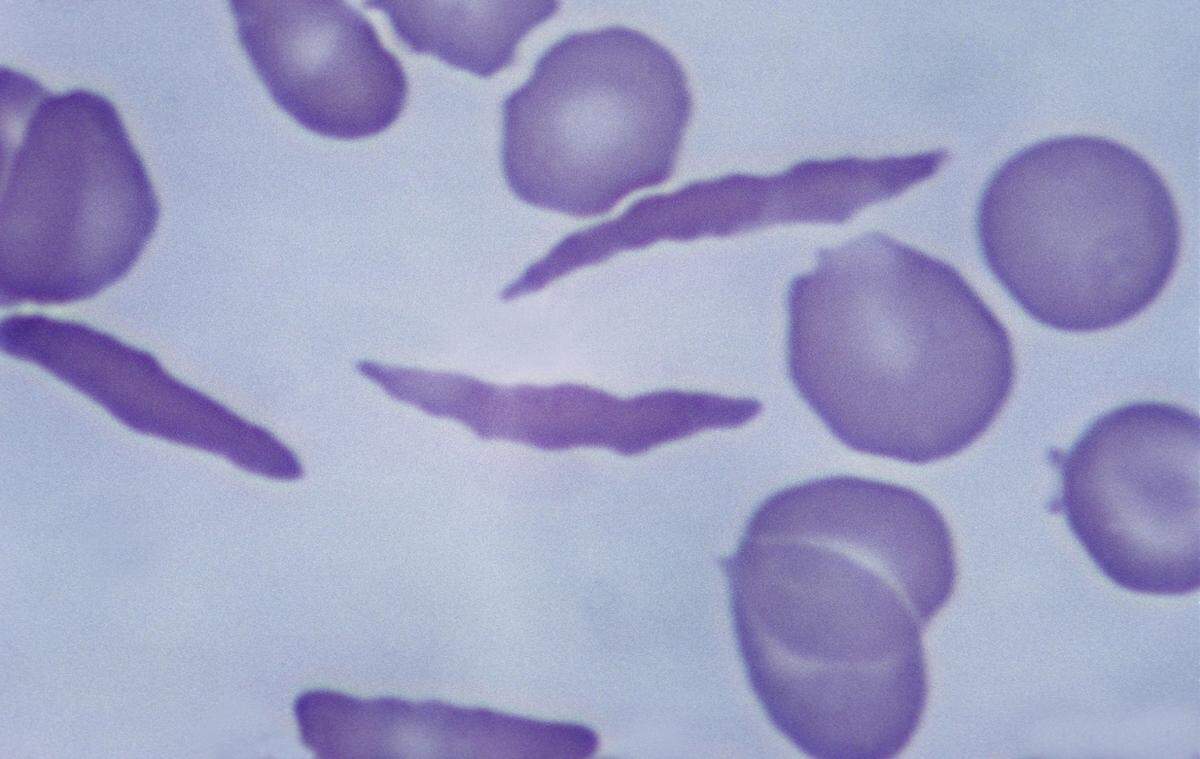 This image shows what sickled cells look like in a person’s blood.