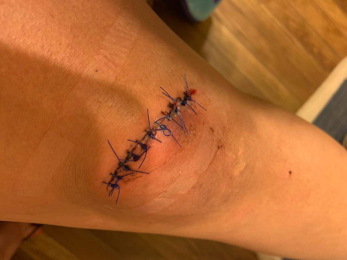 A 26-year-old Fort Worth woman shows the stitches she received on her knee after a city police officer arrested her and her friend on Sept. 3 at America Gardens. A video of their arrest has spread on Twitter, leading to some accusations of excessive force against the officer.