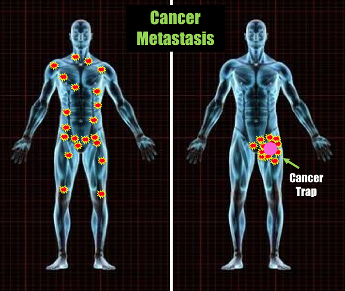 UTA professor Liping Tang's research is focusing on a way to isolate cancer cells and treat them away from healthy tissue.