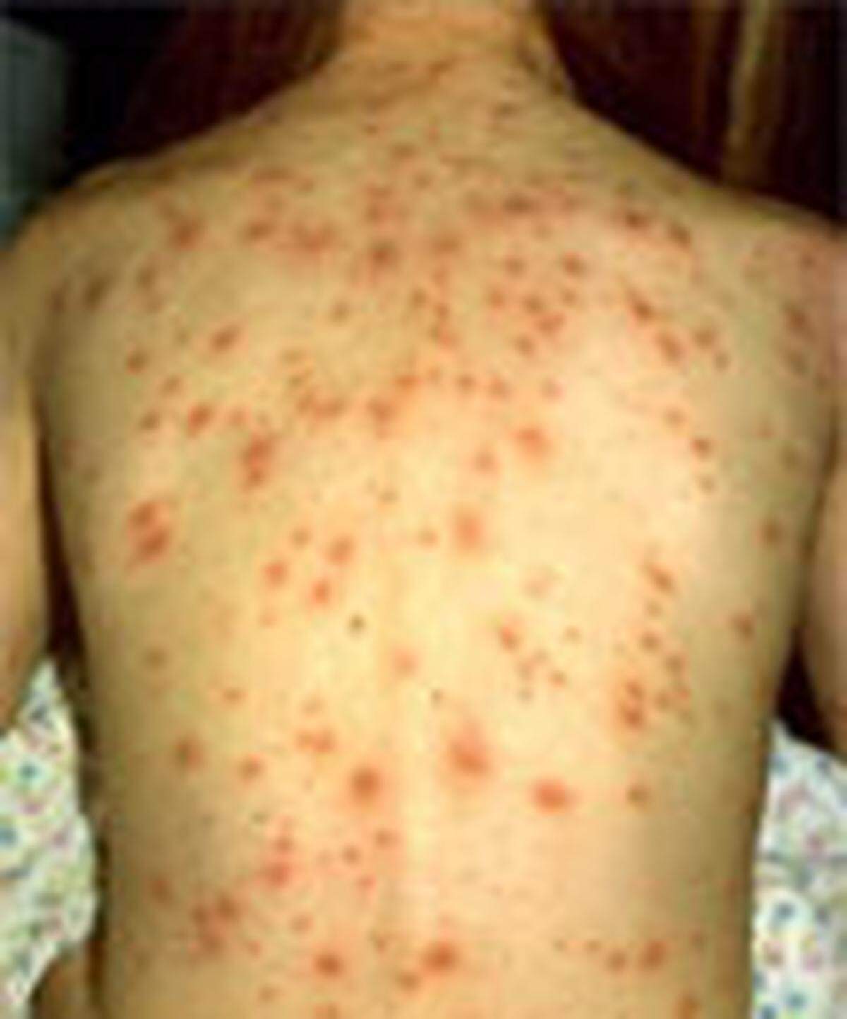 An unvaccinated case of Chickenpox spread across the back.