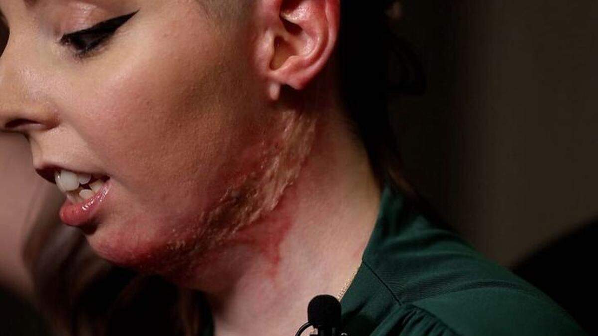 Abigael Hance-Briscoe was hospitalized for seven weeks after being severely burned by a blazing cocktail that exploded into her face and upper body, according to a lawsuit.