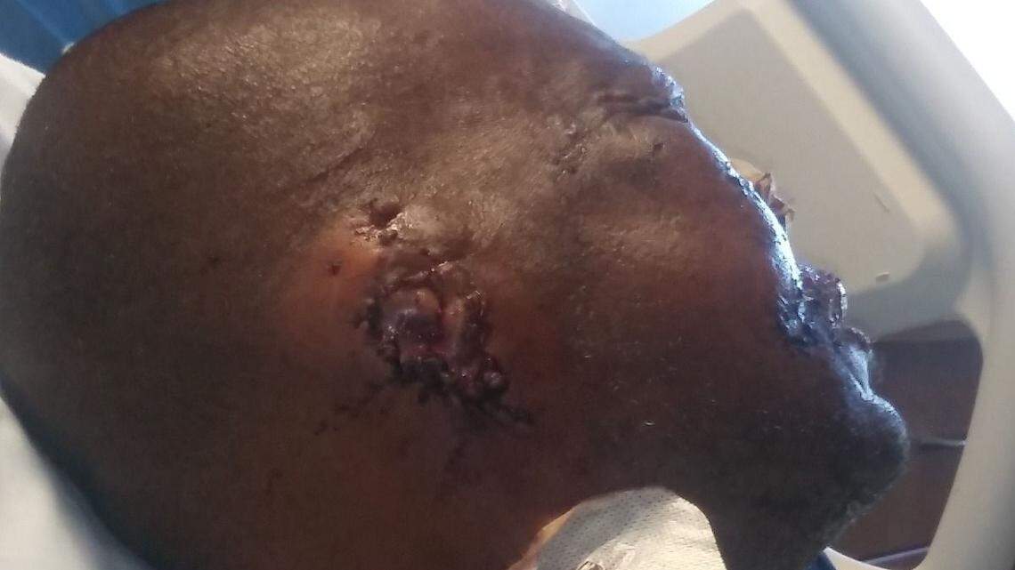 Milton Sturges was attacked by two dogs on Wednesday in Arlington.