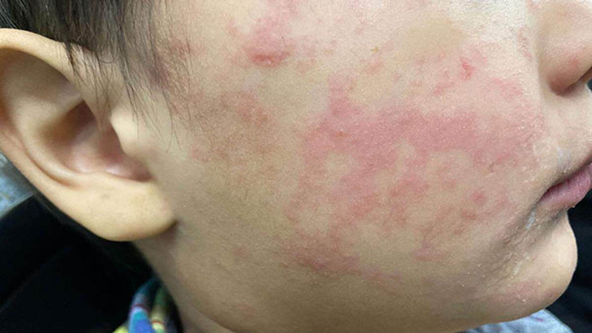 A child’s cheek shows the characteristic rash associated with measles.