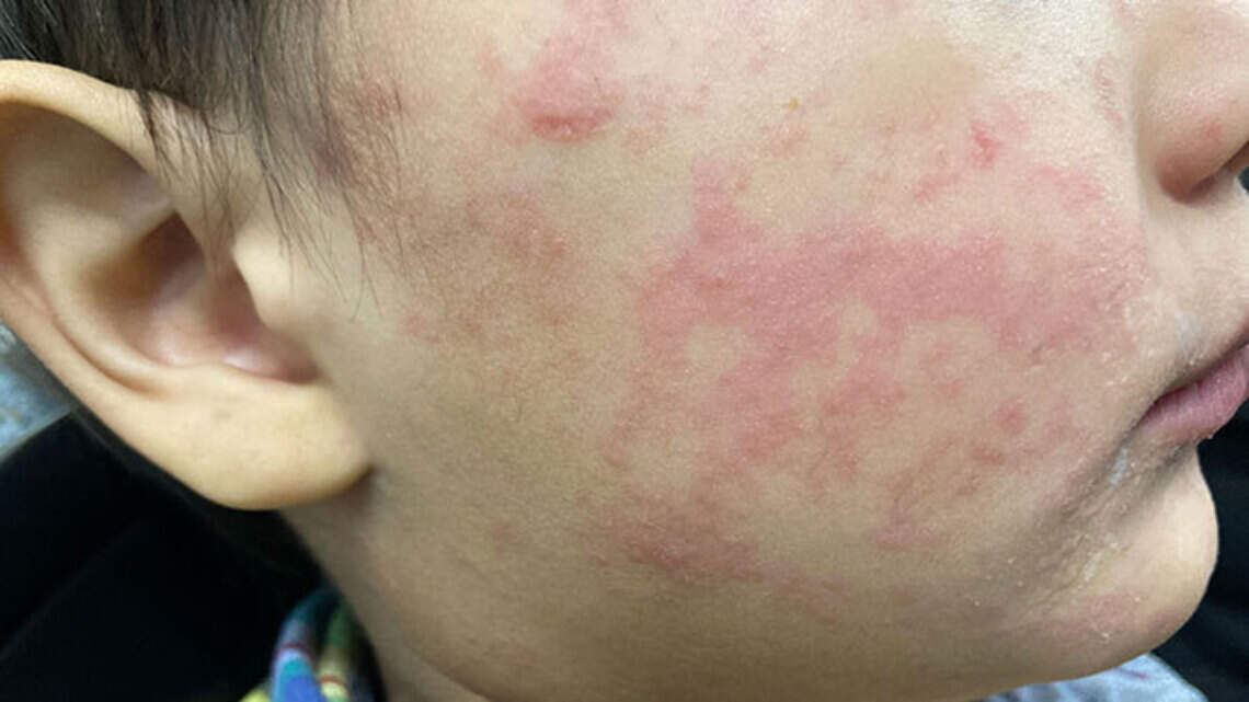 36 more people got measles in Texas this week. These photos show what to watch for