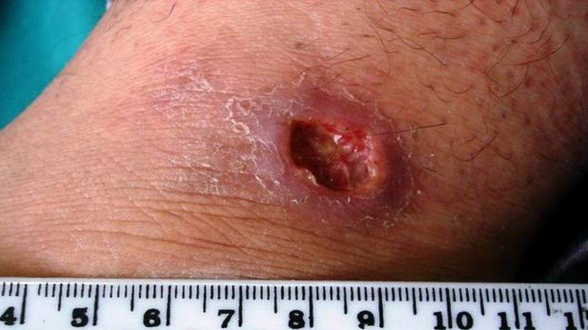 Cutaneous leishmaniasis infections produce skin ulcers that can take weeks or months to emerge post-exposure.