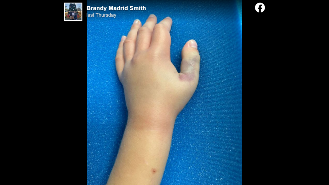 Copperheads inject a painful, flesh-destroying venom.