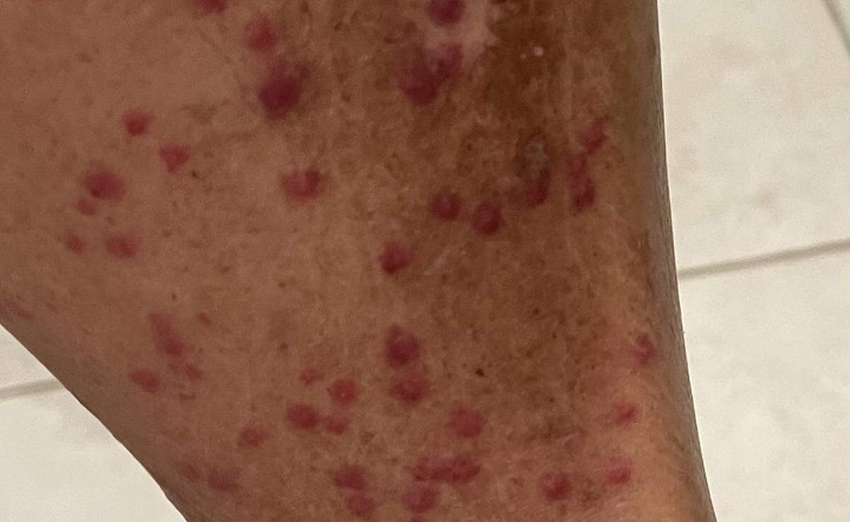 Chigger bites will itch for up to two weeks, usually coming in clusters on the lower leg, ankles and torso.