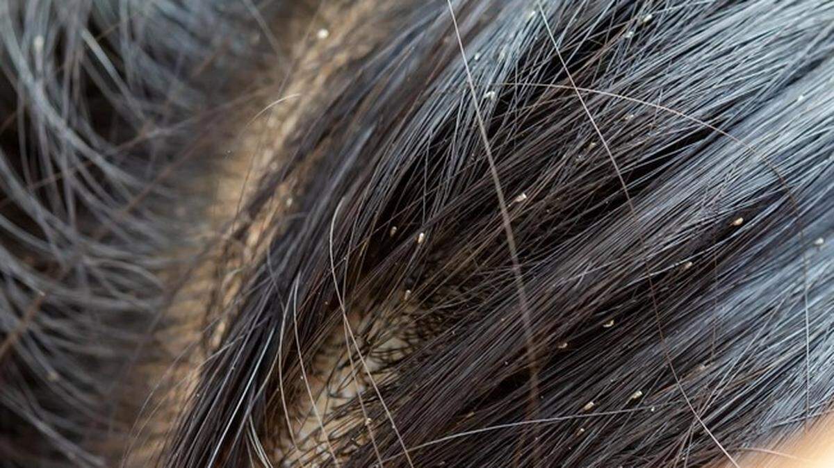 As back to school season starts up, so does the possibility of head lice.