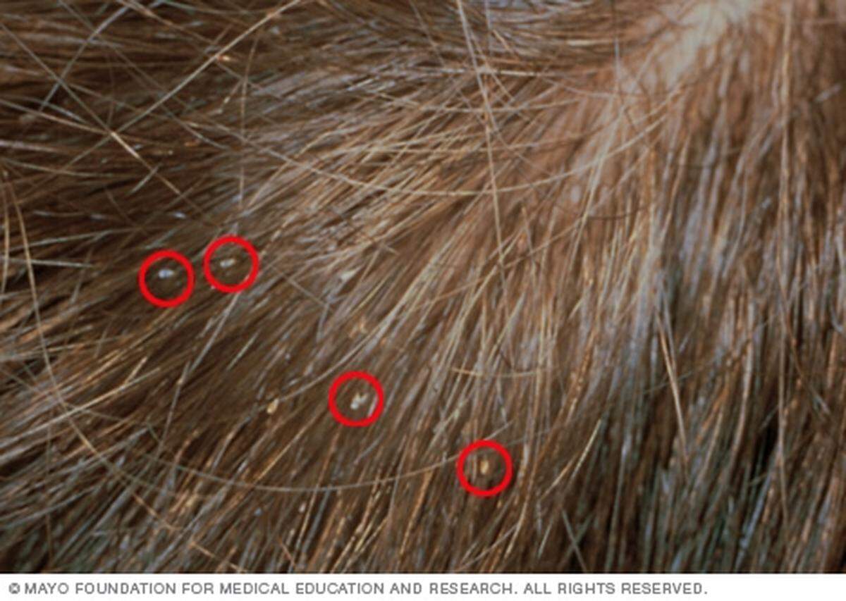It’s hard to know if you have lice, however if your head is itchy and you notice light colored specs, you should seek a comb through treatment.