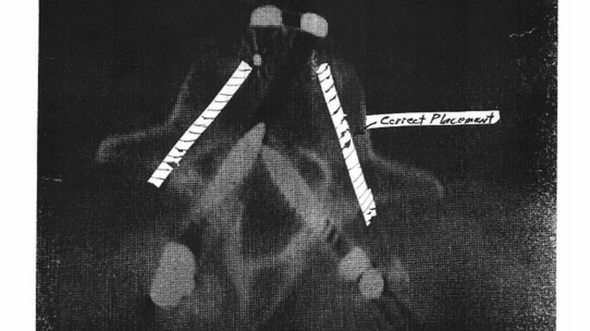 An x-ray shows where two screws should have been placed in a woman’s spine during surgery and where the screws were improperly inserted instead, according to a lawsuit.