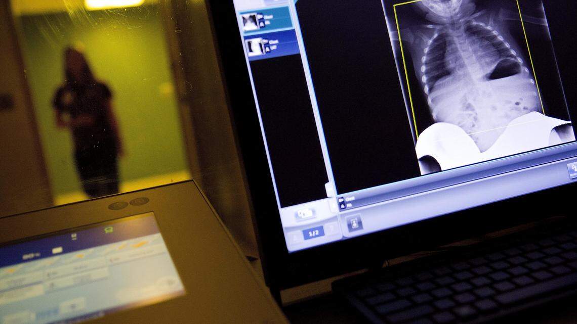 A medical professional at a hospital in Georgia looks at a chest X-ray who has been diagnosed with the flu, which is holding steady across the United States.