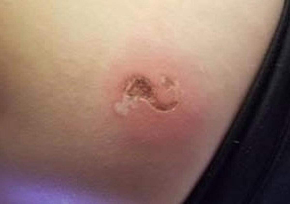 The scar that David Shawn Minze left on his girlfriend.