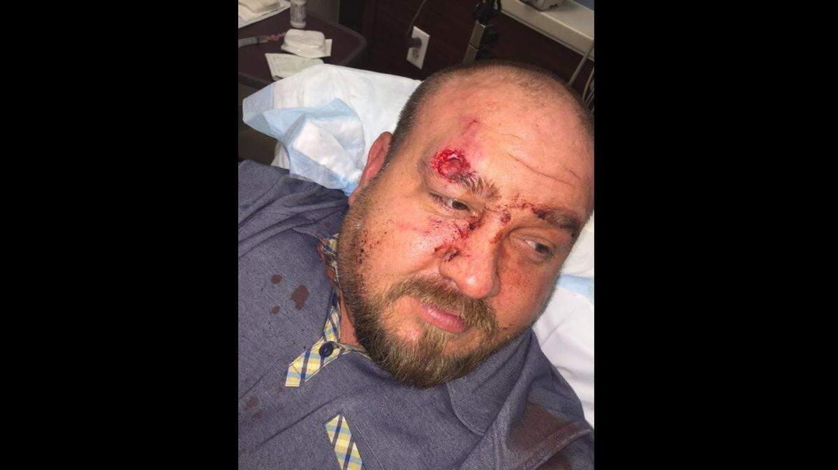 Shawn Merriman told police that an off-duty Fort Worth firefighter bit off a chunk of his forehead in a 2016 bar fight.