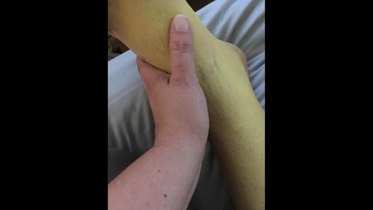 Steve “Opie” Redell, 38, was told by doctors on Aug. 13 he only had days to live as he battles with Myelofibroisis, a rare form of leukemia. The disease attacked his organs, digestive system, his liver and skin leading to discoloration.