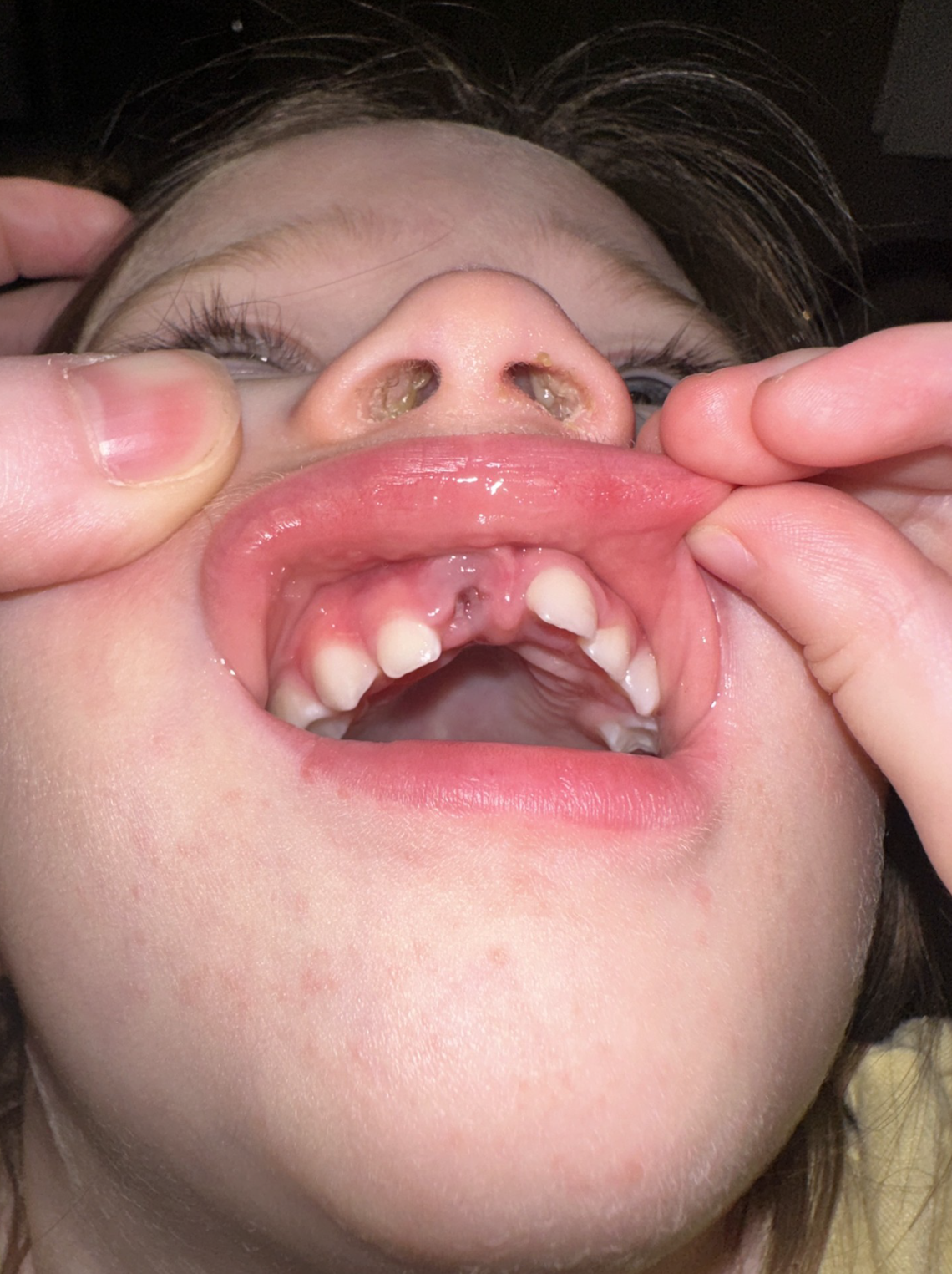 A toddler who tripped on a slippery floor face-first at a child care center in Lewisville is shown with a missing tooth. Her parents are suing The Learning Experience — Castle Hills over allegations that staff neglected their daughter.