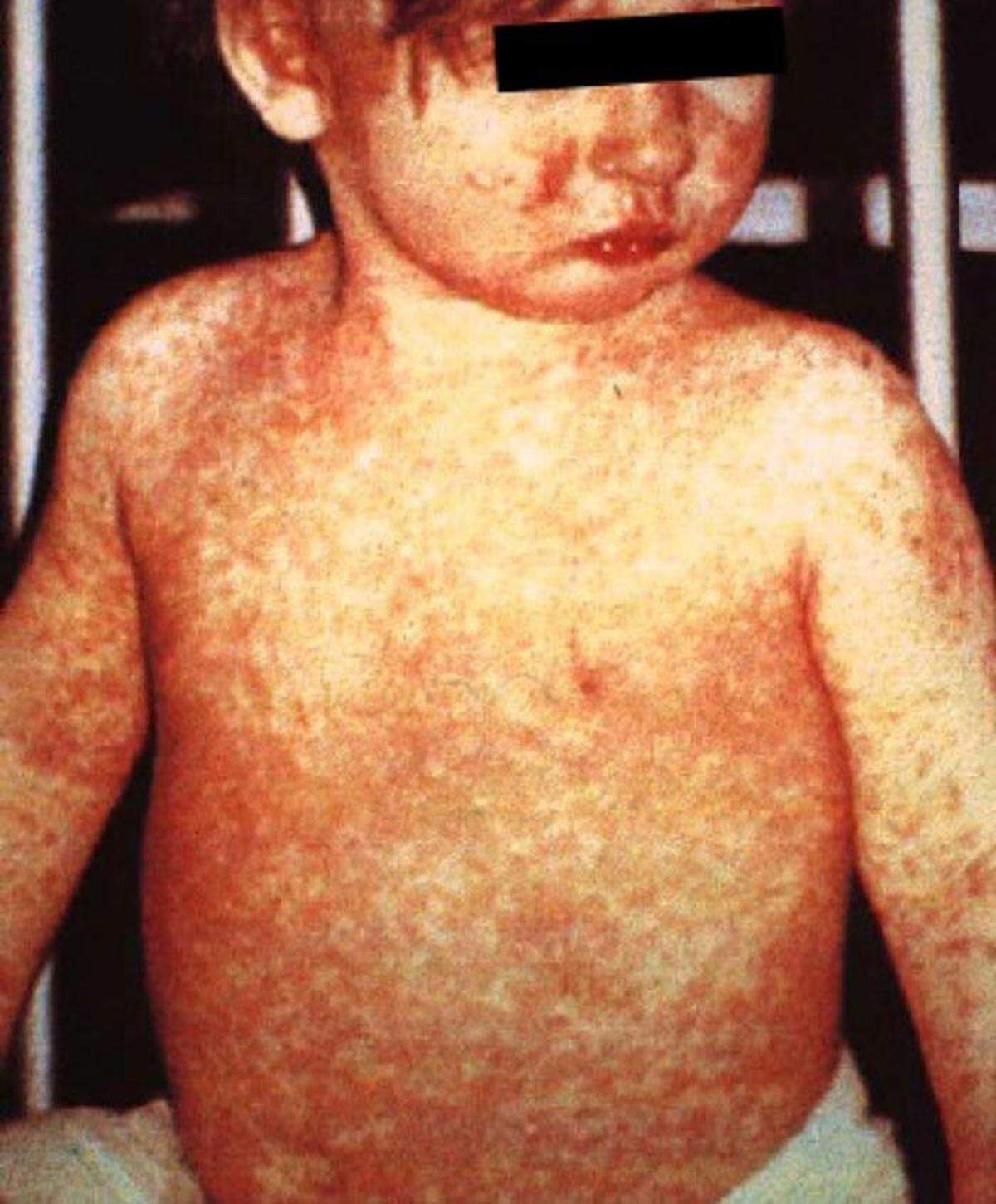 A child with a classic measles rash after four days.