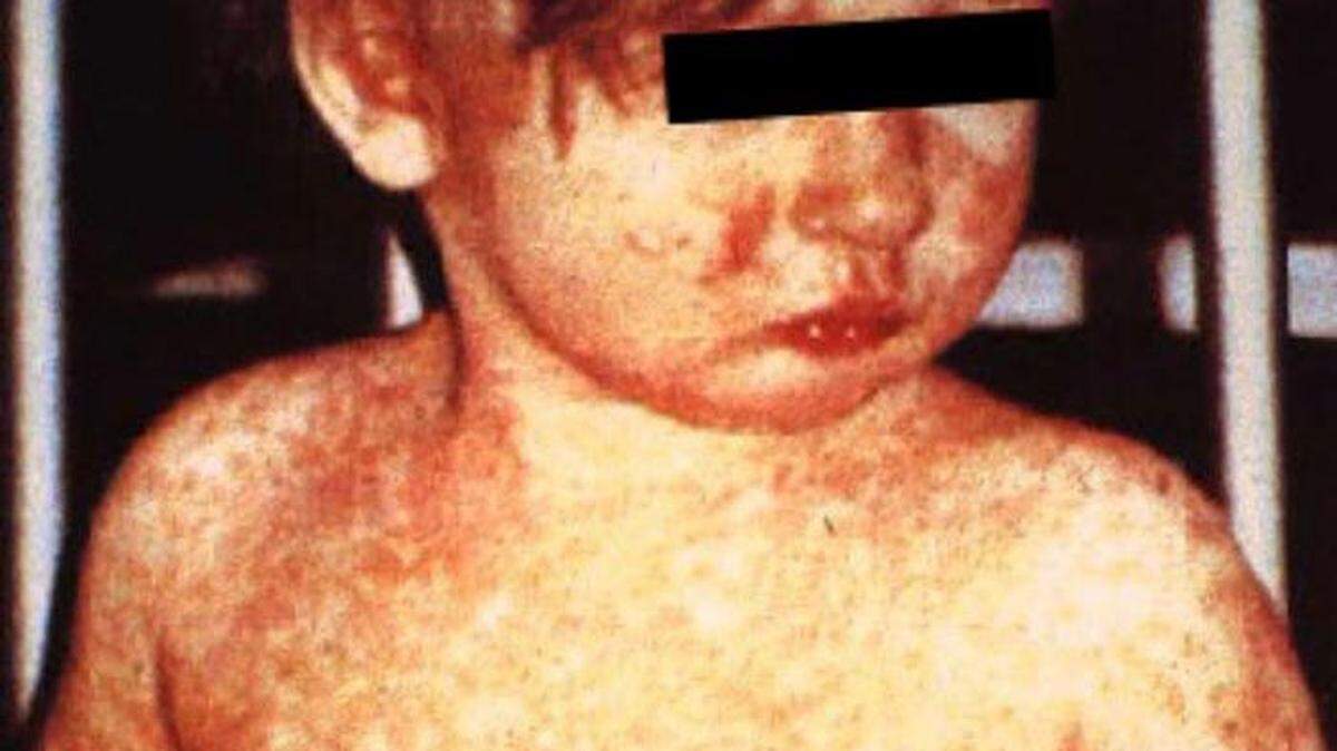 More people in North Texas were exposed to measles at Walmart, Ross and Dollar Tree