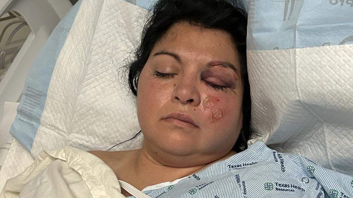 Detention officer Christy Galindo is in the ICU of a Fort Worth hospital after she was severely beaten by three teenage inmates who escaped from a North Texas juvenile facility, according to her family.
