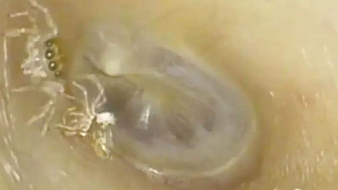A 64-year-old woman presented with a 4-day history of incessant clicking and rustling sounds in her left ear. On examination, a small spider and its exoskeleton were seen in the ear canal.