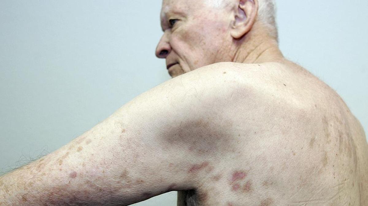 
Wayne Kenyon, 79, shows some of the scarring under his arm and shoulder from shingles at Dr. Keith Wilkerson’s family practice in Arlington on Thursday.

