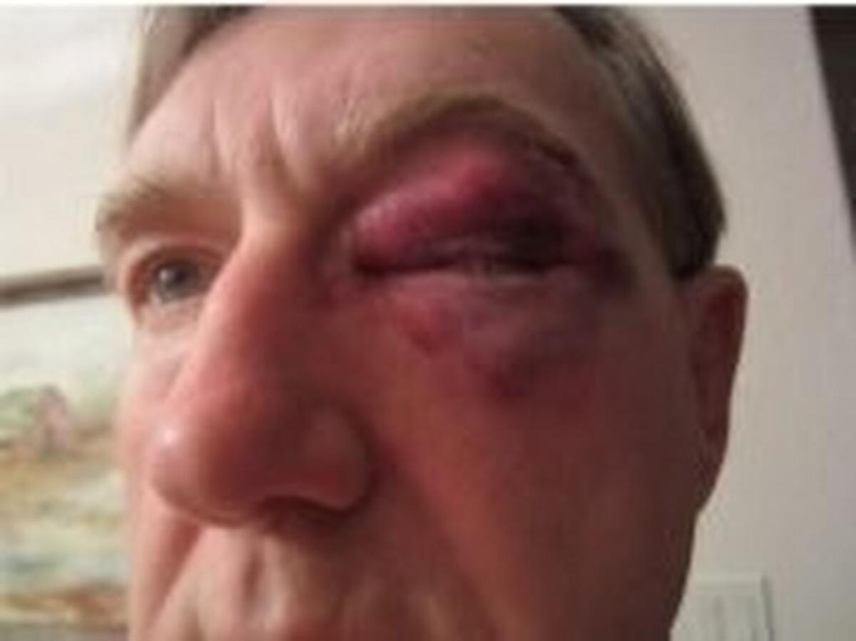 A civil jury awarded David Redelsperger, a retired pharmacist, $725,000 for pain, mental anguish and physical impairment.