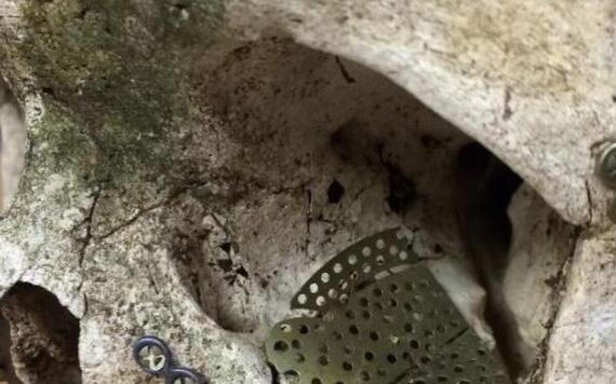 Parker County sheriff’s investigators are seeking the public’s help in identifying a human skull containing surgical mesh and screws from previous extensive damage or injuries.