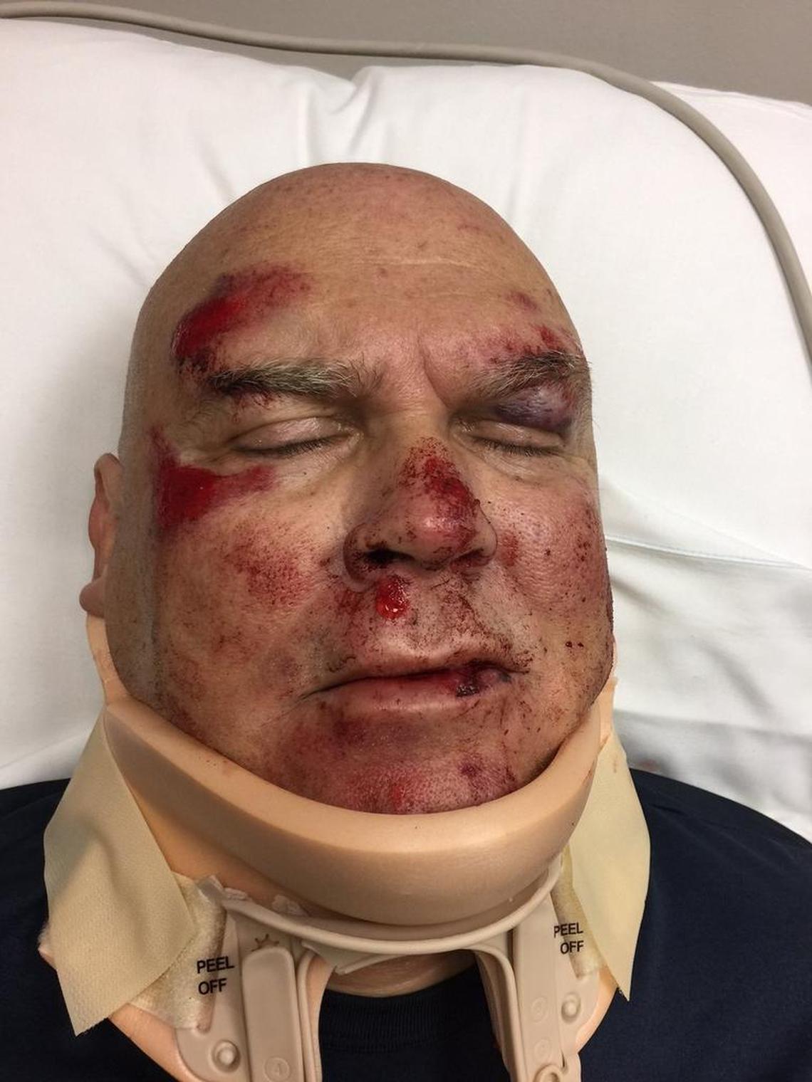 Skip Pepe after the attack in Cravens Park on May 25, 2017.