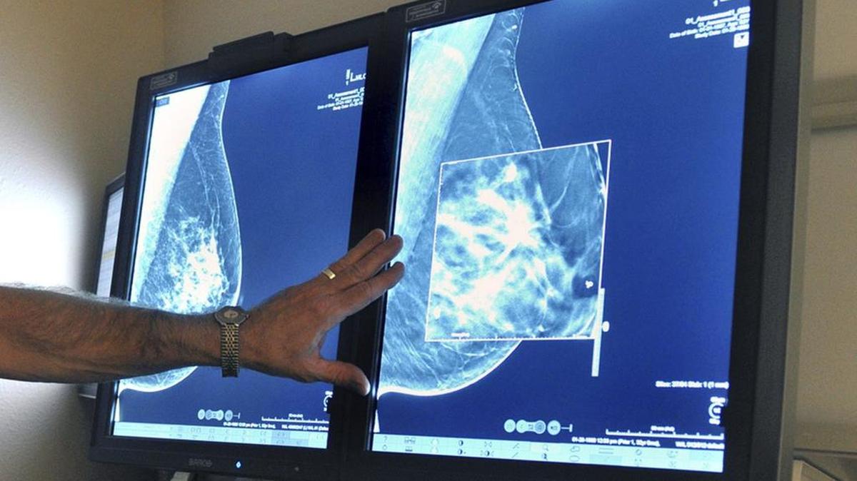 In this file photo, a radiologist compares an image from 2-D technology mammogram to the 3-D Digital Breast Tomosynthesis mammography, which can detect much smaller cancers earlier. ,