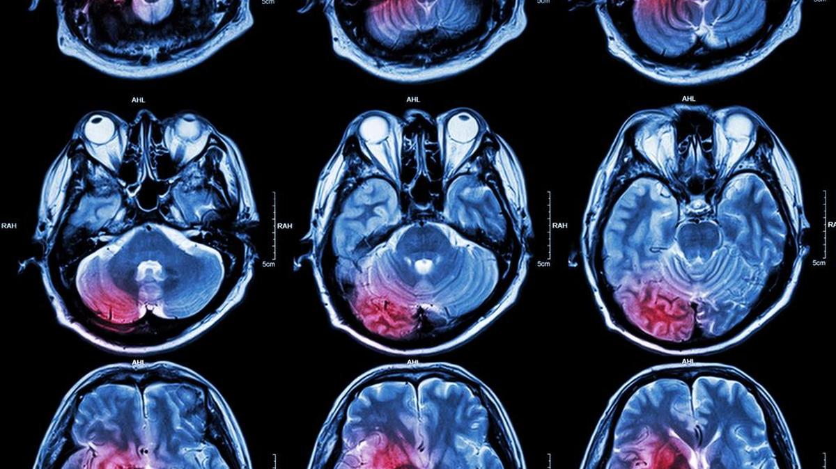 The WWE is accused in the lawsuit of failing to care for wrestlers’ repetitive head injuries “in any medically competent or meaningful manner.”