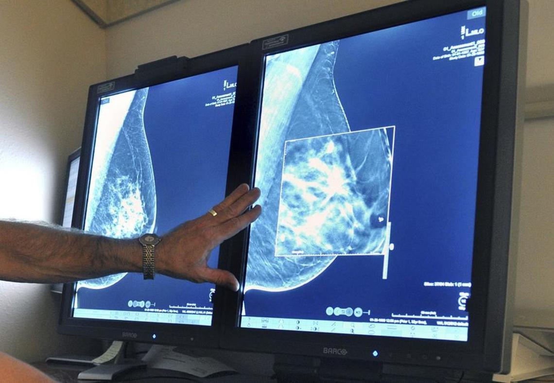 In this file photo, a radiologist compares an image from 2-D technology mammogram to the 3-D Digital Breast Tomosynthesis mammography, which can detect much smaller cancers earlier. ,