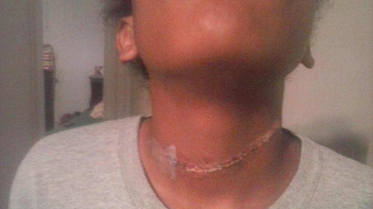 Photos of the rope burns to the 12-year-old girl’s neck were included in the lawsuit filed against Live Oak Classical Academy in Waco.